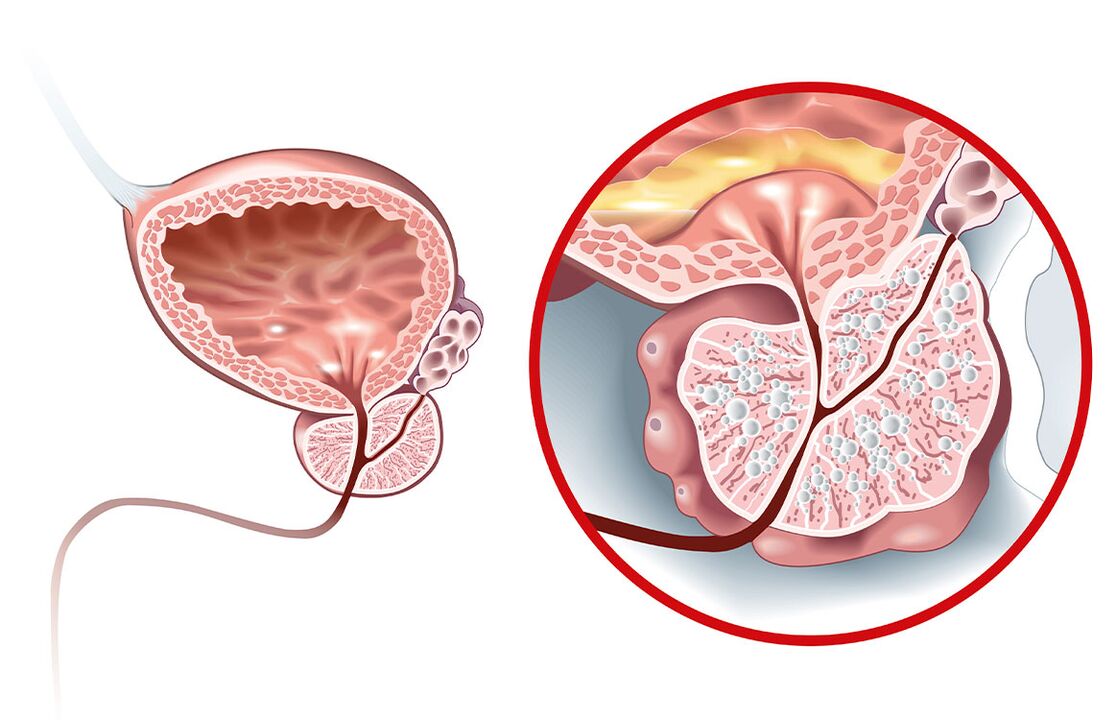 Adenom ve prostatit ile prostatta ne olur