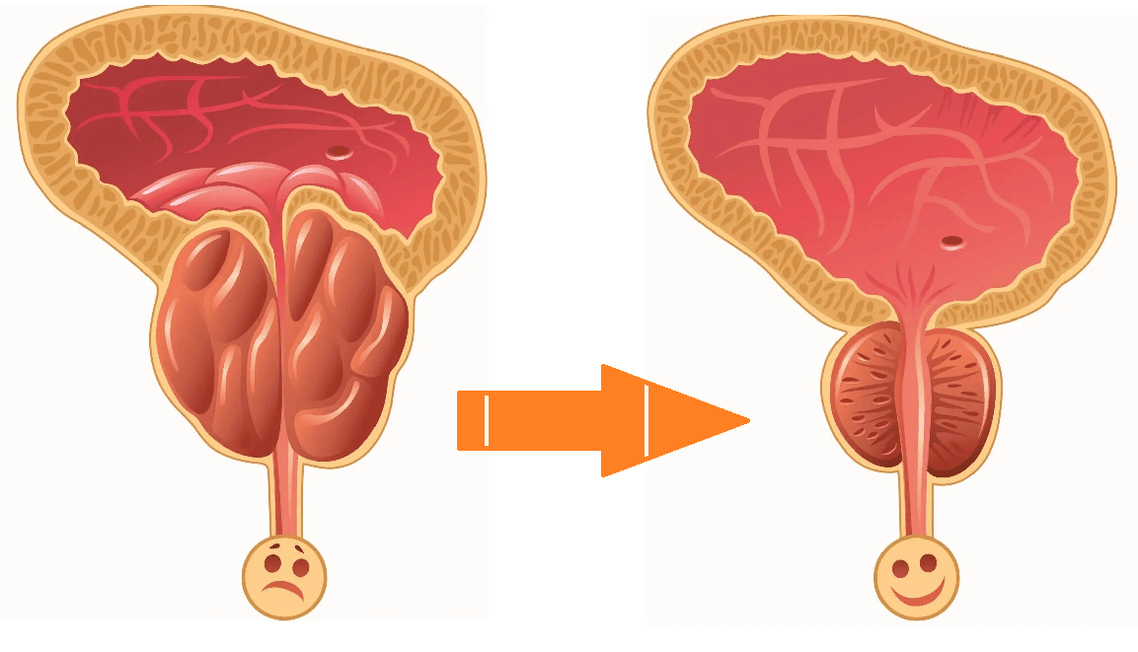 Prostatit ve adenom ile prostat üzerine Uromexil Forte eylemi