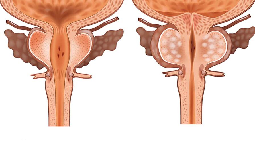 sağlıklı ve iltihaplı adenomun karşılaştırılması