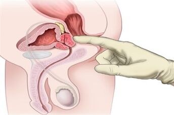 Kronik prostatit tedavisinde prostat masajı