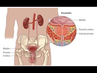 Prostatit – prostat bezinin iltihabı