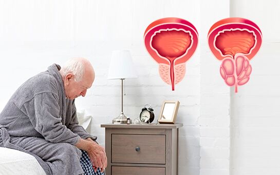 bir erkekte prostatit